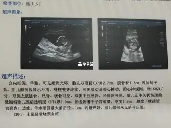 nt值大於1.5mm的生男孩機率大