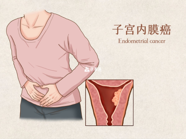 女性患有子宫内膜癌的早期症状多表现为不规则阴道流血