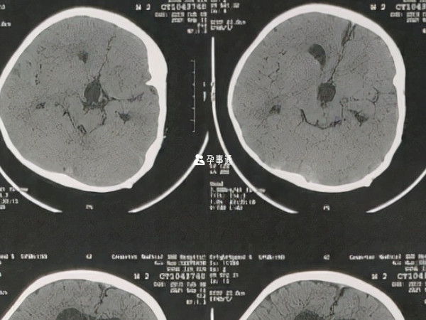 溢奶可能会导致脑积水
