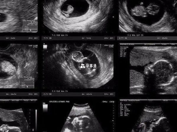 怀孕1个月胎儿真实图