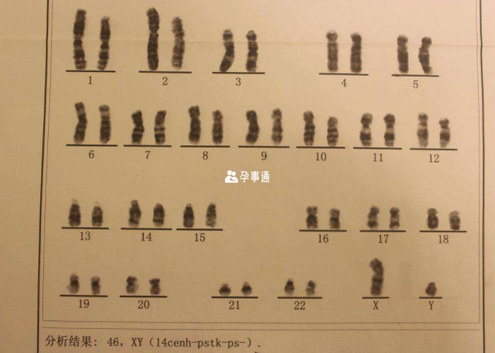 孕前檢查還包括染色體檢查