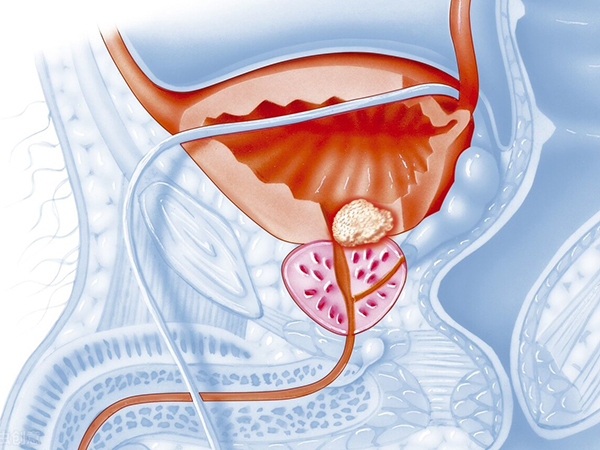 解析前列腺增生会否影响生育
