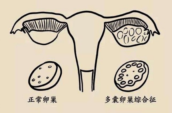 不建議多囊患者服用溴隱亭