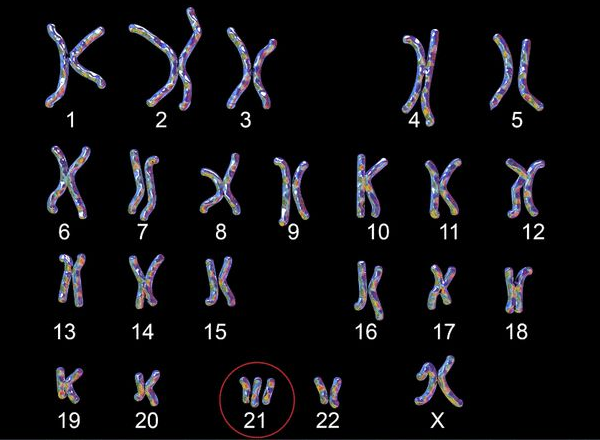 染色体异常会遗传疾病