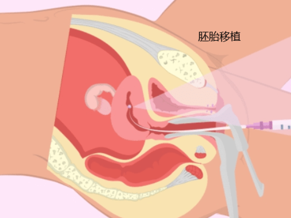 胚胎移植后不能剧烈运动